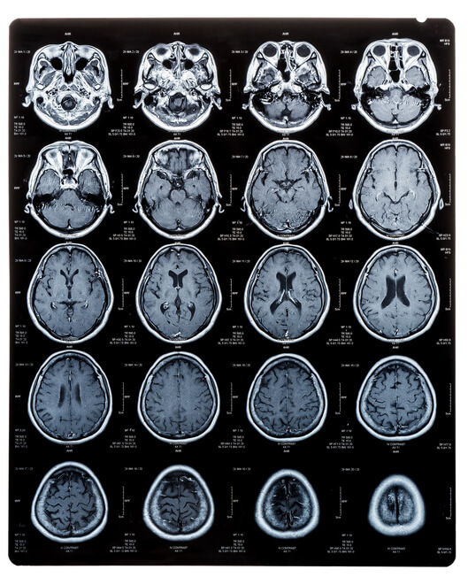 Volumetric brain mri