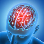 Brain Injuries Can Cause Epilepsy