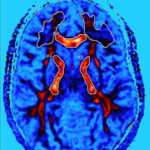Chronic Traumatic Encephalopathy (CTE) Brain Injuries