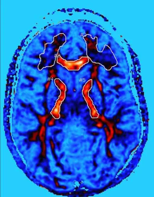 cte treatment
