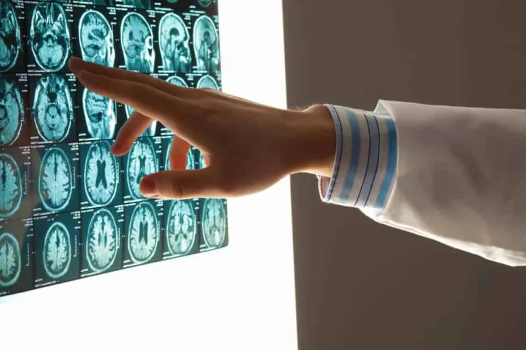 brain injury lawsuit settlements