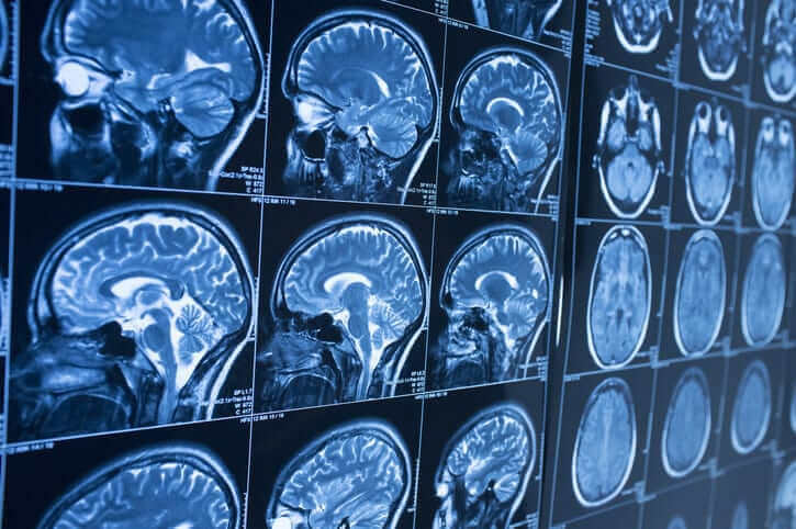 symptoms of a mild traumatic brain injury