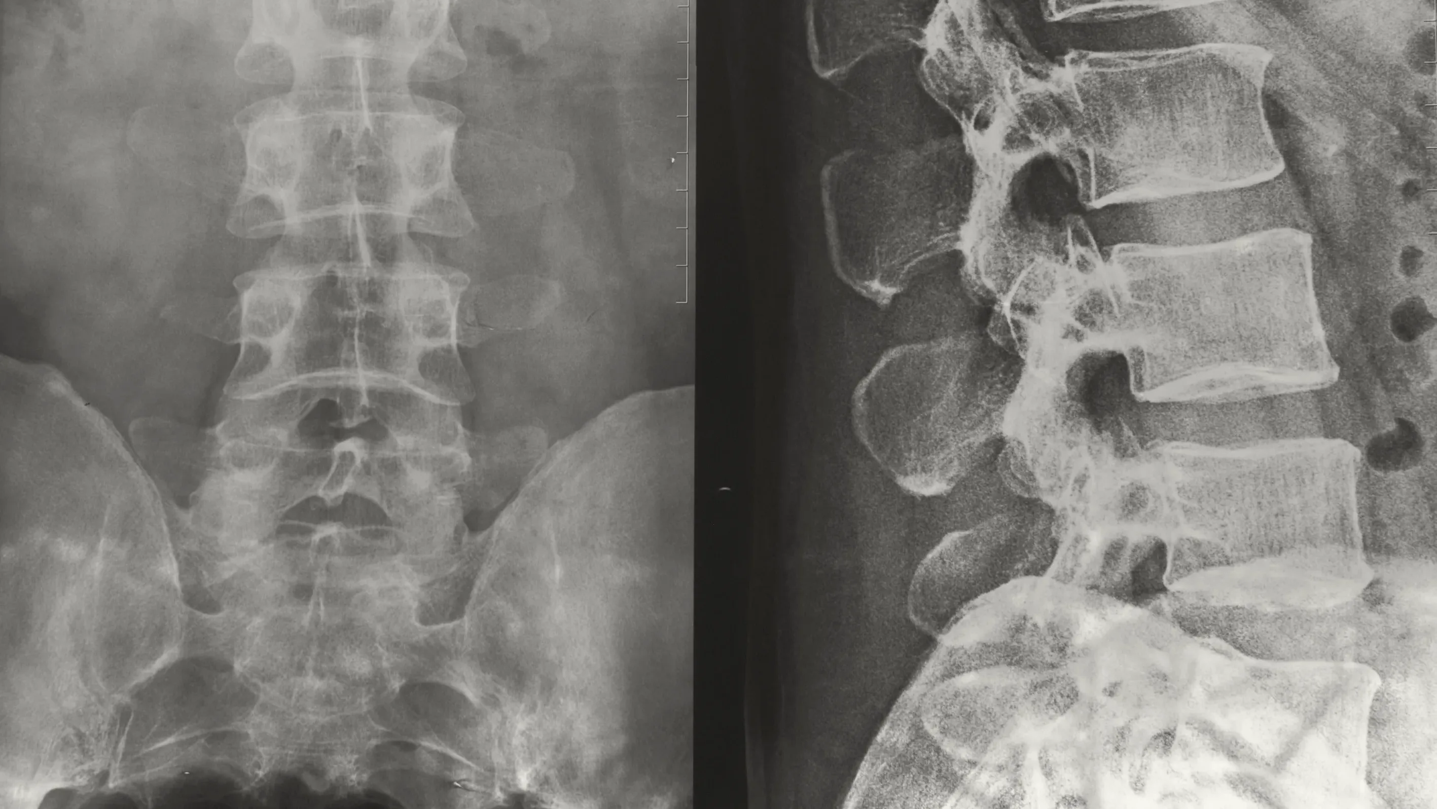 spinal cord imaging